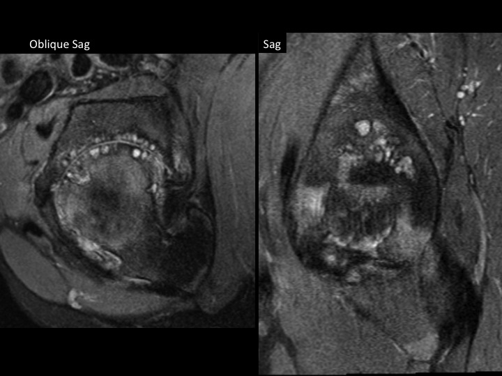 Figure 5 for case acetabular-femoral impingement